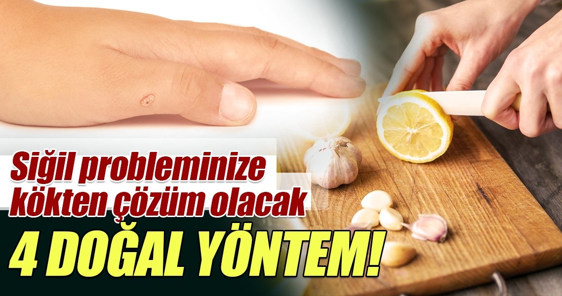 Siğil Nedir? Siğil Nasıl Geçer? Evde Siğil İçin Doğal Tedavi