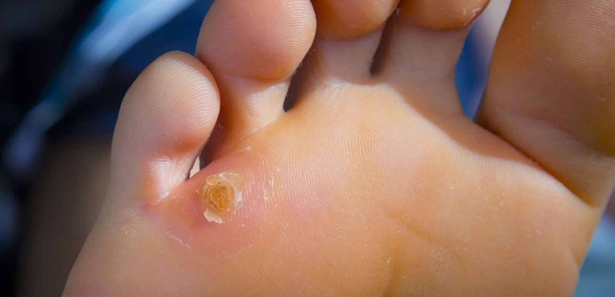 Nasır Nedir? Neden Olur? Nasır’a Ne İyi Gelir